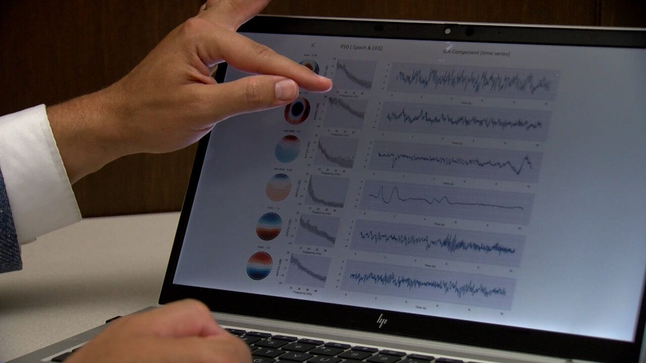 AI-Enhanced EEG Analysis: A Breakthrough in Early Dementia Detection